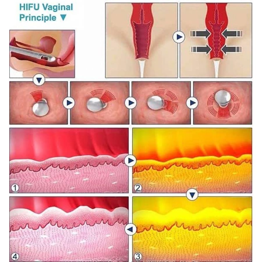 Hifu Wrinkle Removal Vaginal Tightening Machine